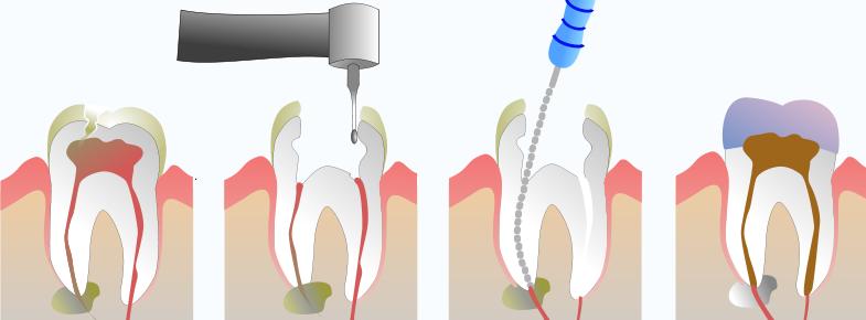 endodontia01