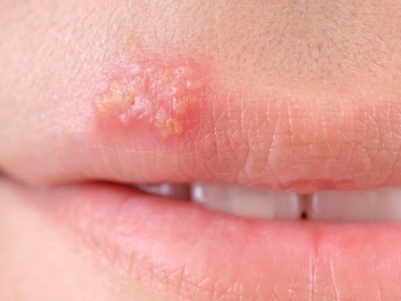 herpes 1